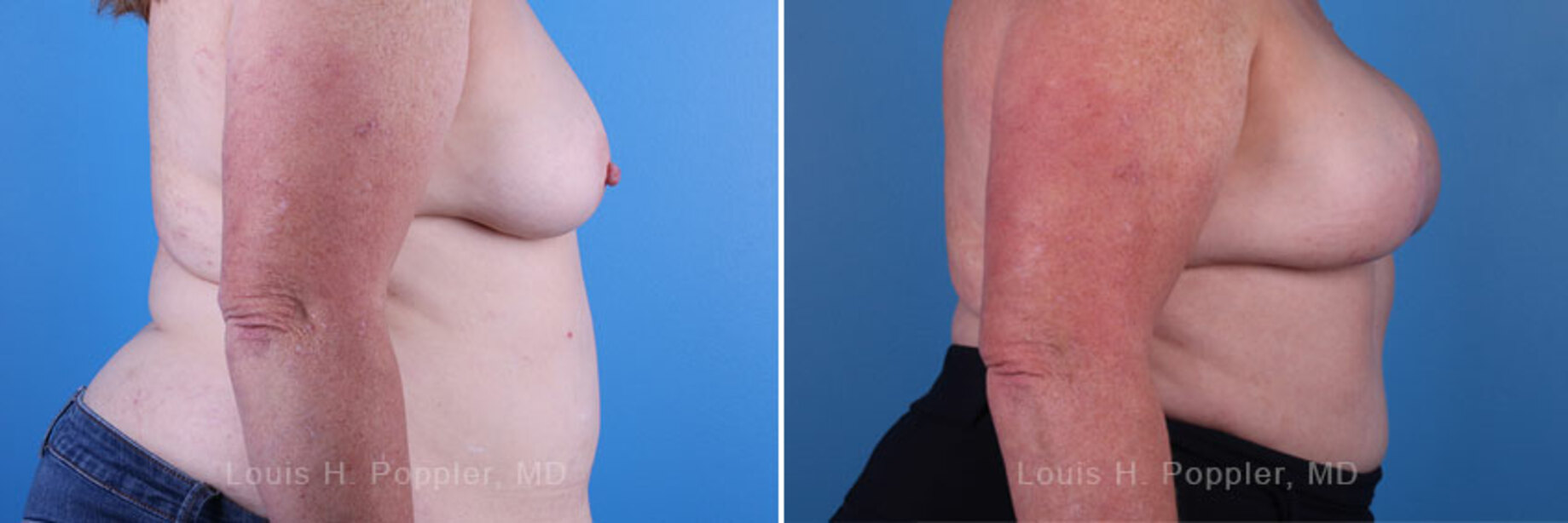 Breast reconstruction surgery before and after photos, right 90-degree angle view