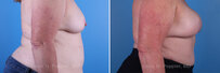 Breast reconstruction surgery before and after photos, right 90-degree angle view