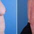 Breast reconstruction surgery before and after photos, right 90-degree angle view