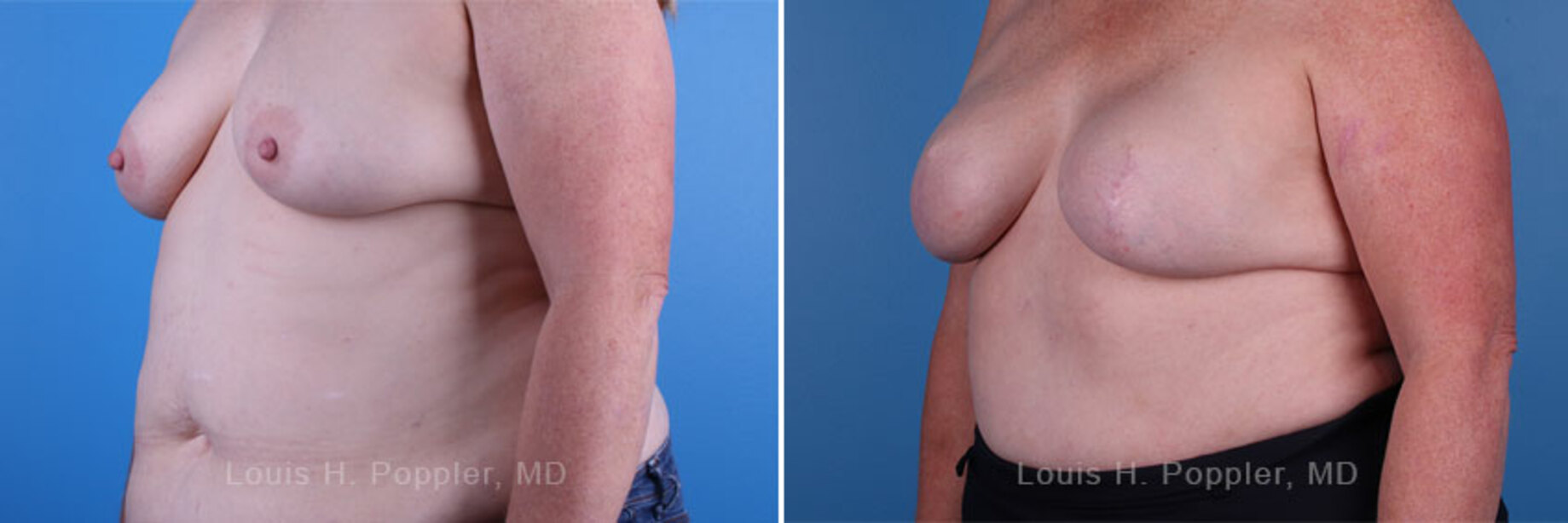 Breast reconstruction surgery before and after photos, left 45-degree angle view