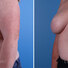 Breast reconstruction surgery before and after photos, left 45-degree angle view