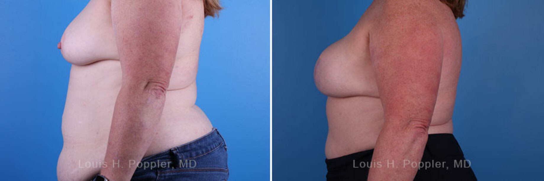 Breast reconstruction surgery before and after photos, left 90-degree angle view