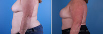 Breast reconstruction surgery before and after photos, left 90-degree angle view