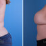 Breast reconstruction surgery before and after photos, left 90-degree angle view