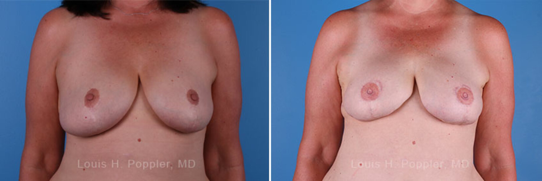Breast reconstruction surgery before and after photos