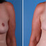 Breast reconstruction surgery before and after photos