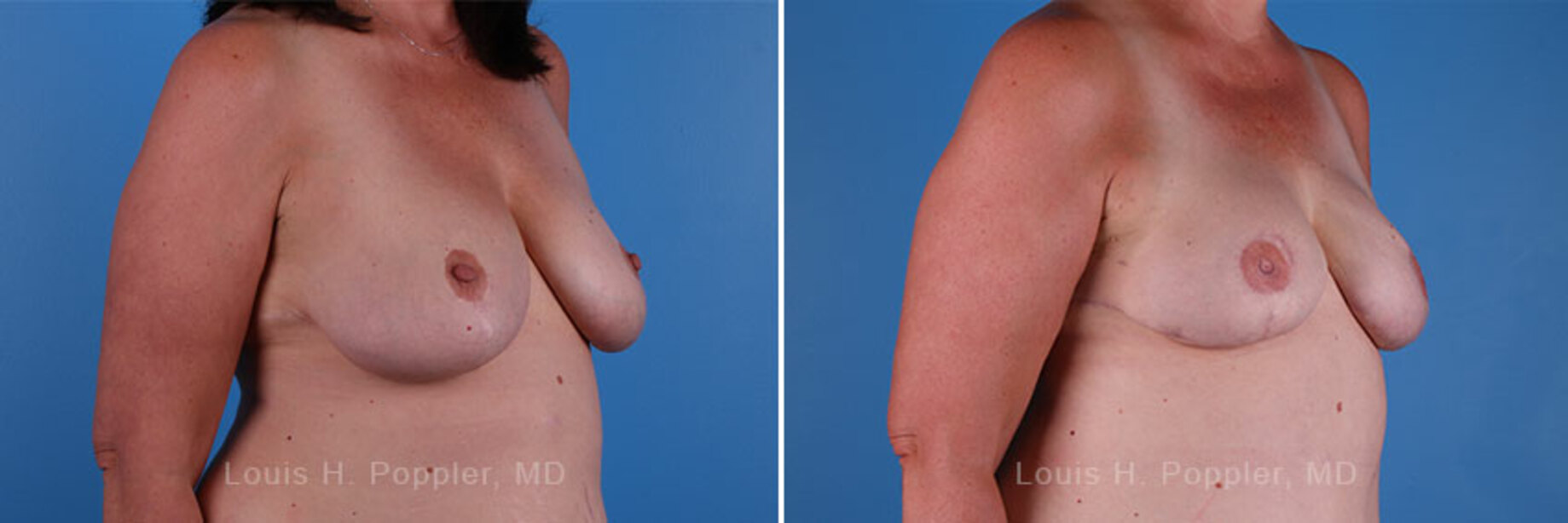 Breast reconstruction surgery before and after photos, right 45-degree angle view