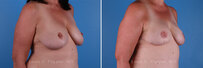 Breast reconstruction surgery before and after photos, right 45-degree angle view