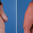 Breast reconstruction surgery before and after photos, right 45-degree angle view