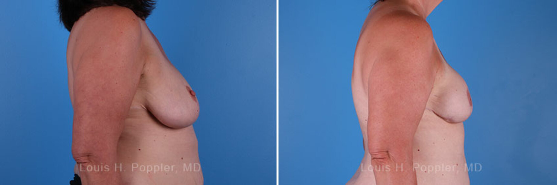 Breast reconstruction surgery before and after photos, right 90-degree angle view