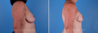 Breast reconstruction surgery before and after photos, right 90-degree angle view