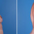 Breast reconstruction surgery before and after photos, right 90-degree angle view