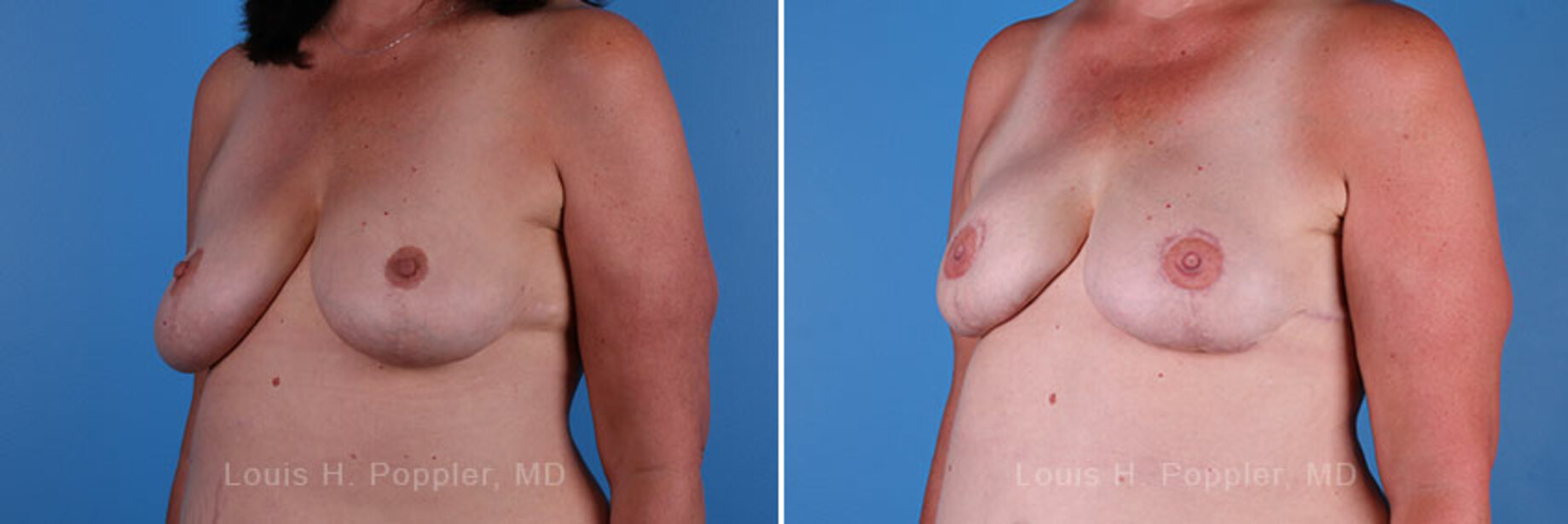 Breast reconstruction surgery before and after photos, left 45-degree angle view