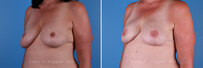 Breast reconstruction surgery before and after photos, left 45-degree angle view