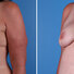 Breast reconstruction surgery before and after photos, left 45-degree angle view