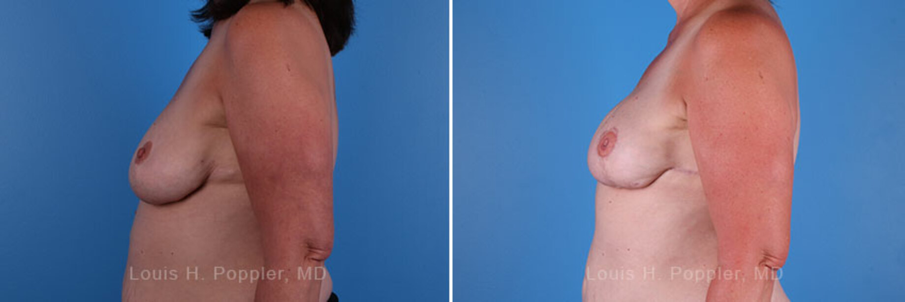 Breast reconstruction surgery before and after photos, left 90-degree angle view