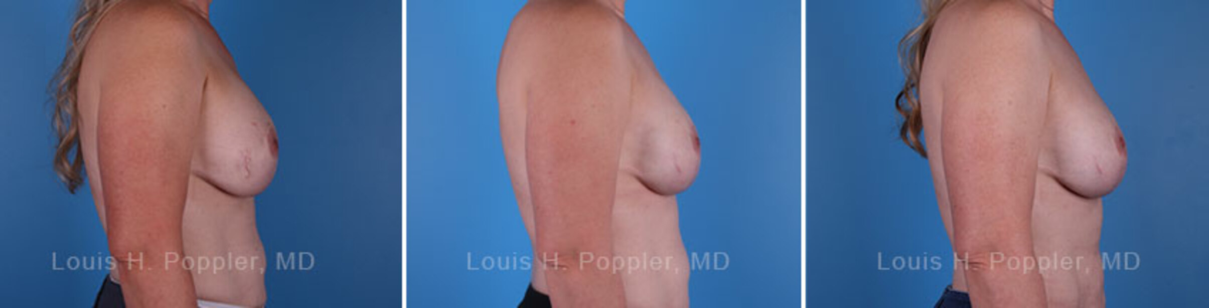 Breast reconstruction surgery before and after photos, right 90-degree angle view