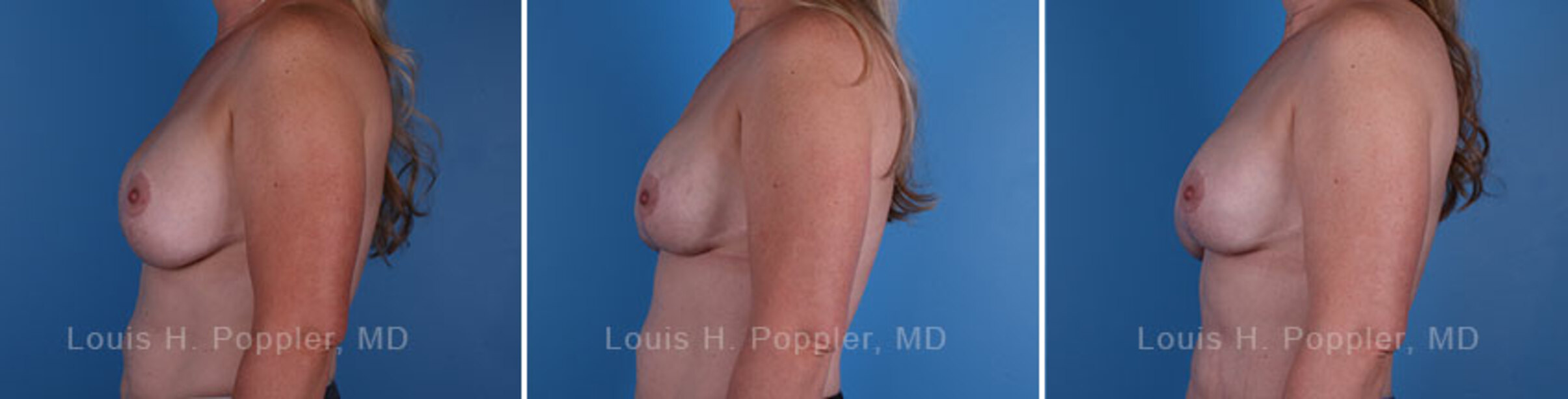 Breast reconstruction surgery before and after photos, left 90-degree angle view