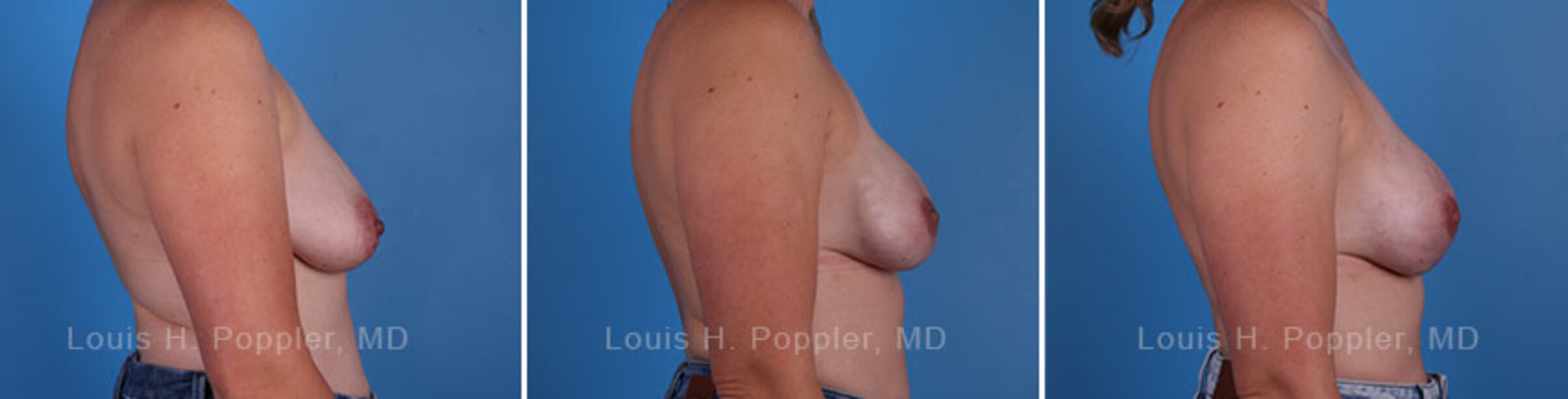Breast reconstruction surgery before and after photos, right 90-degree angle view
