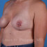 Breast reconstruction surgery before and after photos, left 45-degree angle view