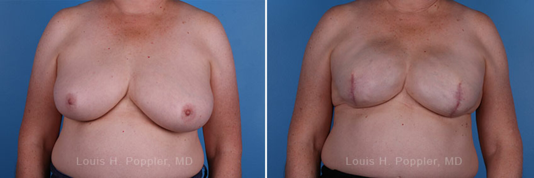 Breast reconstruction surgery before and after photos