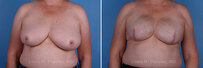 Breast reconstruction surgery before and after photos