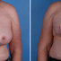 Breast reconstruction surgery before and after photos