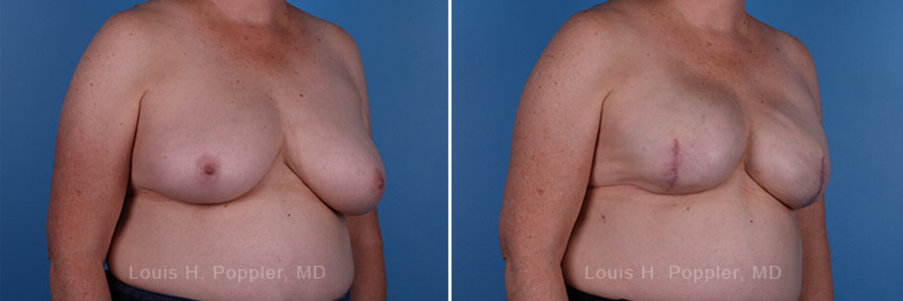 Breast reconstruction surgery before and after photos, right 45-degree angle view