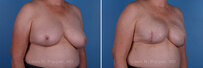 Breast reconstruction surgery before and after photos, right 45-degree angle view