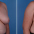 Breast reconstruction surgery before and after photos, right 45-degree angle view