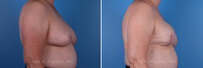 Breast reconstruction surgery before and after photos, right 90-degree angle view