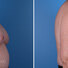 Breast reconstruction surgery before and after photos, right 90-degree angle view