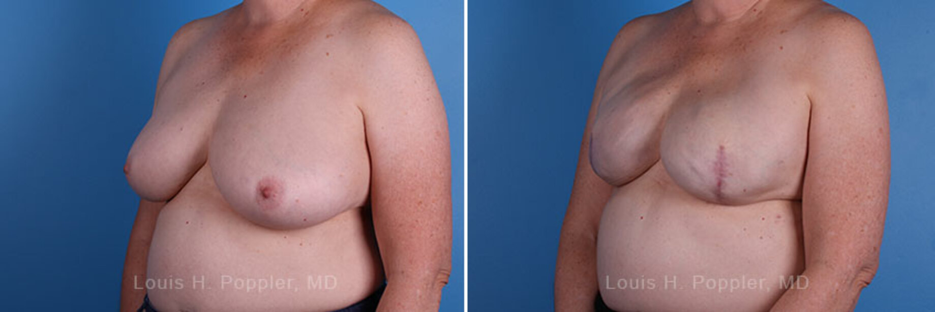 Breast reconstruction surgery before and after photos, left 45-degree angle view