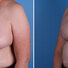 Breast reconstruction surgery before and after photos, left 45-degree angle view