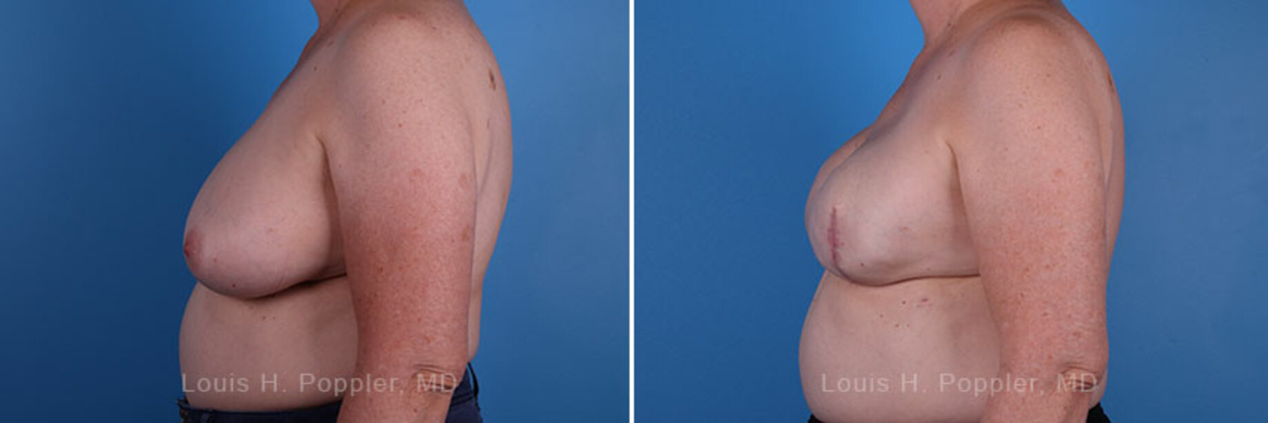 Breast reconstruction surgery before and after photos, left 90-degree angle view