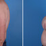 Breast reconstruction surgery before and after photos, left 90-degree angle view