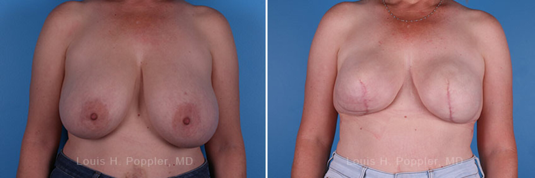 Breast reconstruction surgery before and after photos