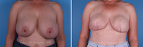 Breast reconstruction surgery before and after photos