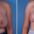 Breast reconstruction surgery before and after photos
