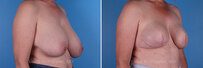 Breast reconstruction surgery before and after photos, right 45-degree angle view