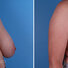 Breast reconstruction surgery before and after photos, right 45-degree angle view