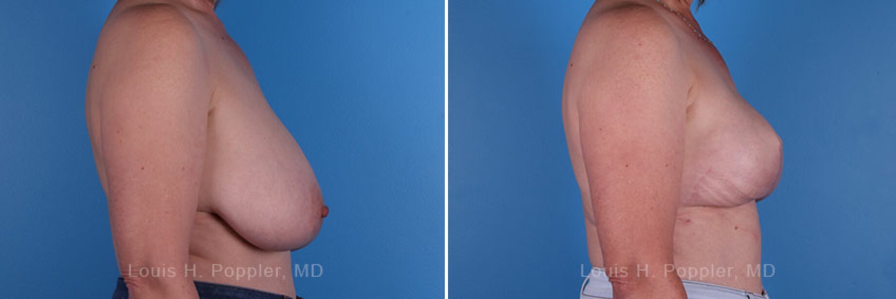 Breast reconstruction surgery before and after photos, right 90-degree angle view