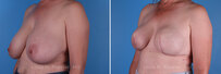 Breast reconstruction surgery before and after photos, left 45-degree angle view