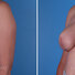 Breast reconstruction surgery before and after photos, left 45-degree angle view