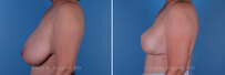 Breast reconstruction surgery before and after photos, left 90-degree angle view