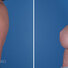 Breast reconstruction surgery before and after photos, left 90-degree angle view