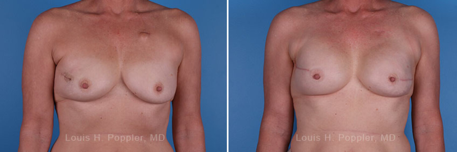 Breast reconstruction surgery before and after photos