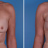Breast reconstruction surgery before and after photos