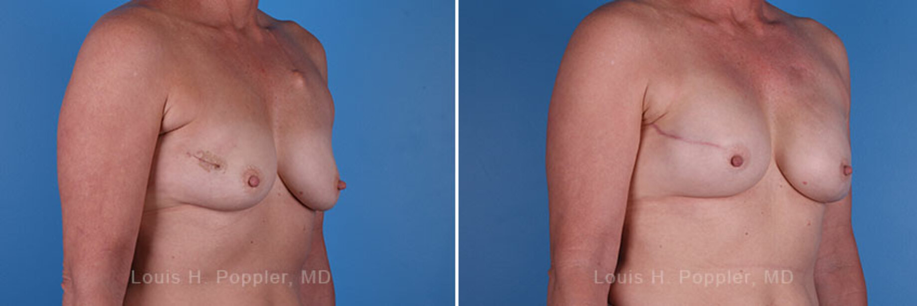 Breast reconstruction surgery before and after photos, right 45-degree angle view