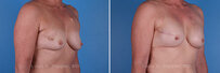 Breast reconstruction surgery before and after photos, right 45-degree angle view